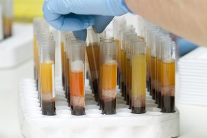 Il plasma iperimmune può curare Covid-19: fiale in laboratorio