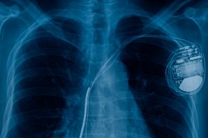L’iPhone 12 può disattivare defibrillatori e pacemaker