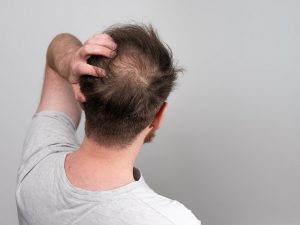 Covid-19 può causare la caduta dei capelli