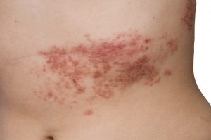 dopo covid-19 aumenta il rischio di herpes zoster