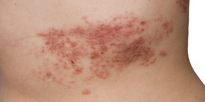 dopo covid-19 aumenta il rischio di herpes zoster