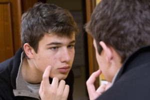il cioccolato fa venire l'acne ragazzi