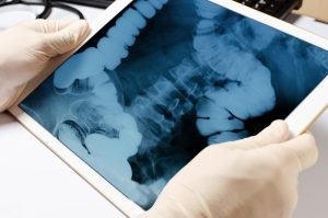 l’attività fisica blocca il tumore al colon senza chemioterapia terapie