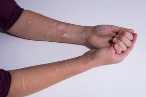 Braccia con cicatrici compatibili con precedenti atti di autolesionismo non suicidario, segno clinico che richiede attenzione, ascolto e supporto specialistico.